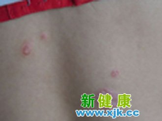 牛皮癬輔助治療很重要